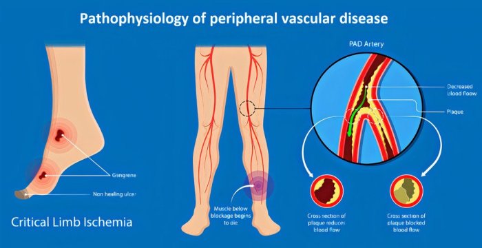 Peripheral vascular disease nclex questions