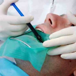 Canal root instruments treatment dental