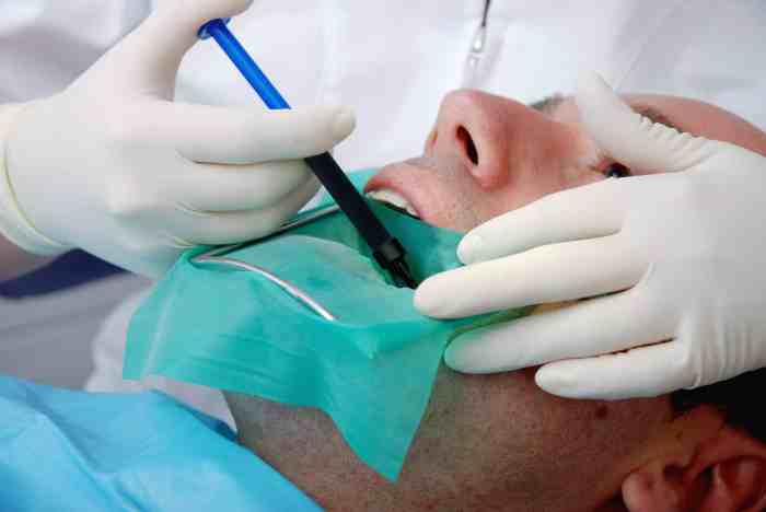 Canal root instruments treatment dental